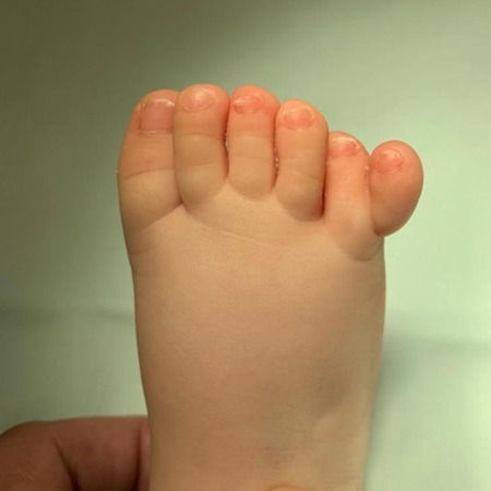 Polidactilia